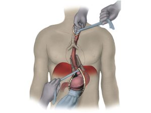 20211117_cac-cach-tiep-can-khi-mo-thuc-quan-mo-nguc