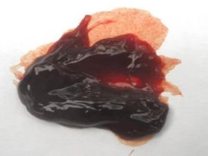 Cục-máu-kinh-lớn