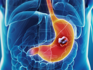 benh-ung-thu-da-day-1