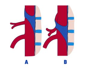 hinh-anh-minh-hoa-day-chang-binh-thuong-va-hoi-chung-day-chang-cung-giua