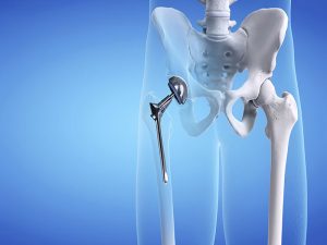 khop-hang-nhan-tao-1