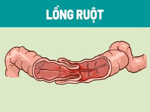mot-phan-ruot-bi-truot-vao-doan-ruot-ke-ben