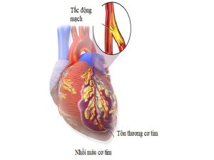 nhoi-mau-co-tim-la-gi