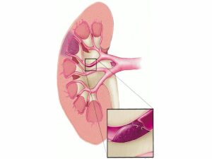 VIÊM BAO QUY ĐẦU - 487