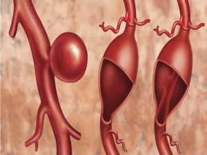 Phình ĐMC ngực - phinh-dong-mach-chu-nguc-1