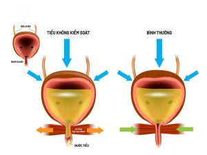 tieu-khong-kiem-soat-la-gi