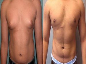 tuyen-vu-phat-trien-bat-thuong-cua-benh-klinefelter